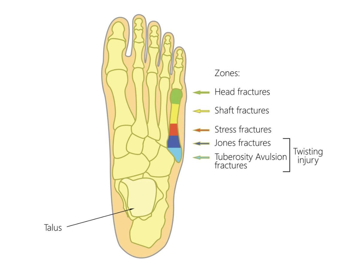 Tuberosity Of 5th Metatarsal Pain